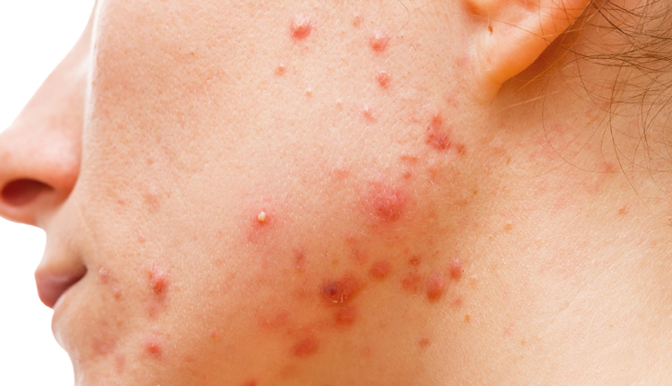 witch hazel skincare benefits,reasons to use witch hazel in skincare,witch hazel for healthy skin,natural skincare with witch hazel,benefits of witch hazel in skincare routine,witch hazel toner benefits,witch hazel for acne-prone skin,skin benefits of using witch hazel,witch hazel as a facial cleanser,incorporating witch hazel into skincare regimen