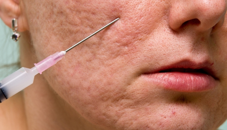 pitted acne scars remedies,treating pitted acne scars,get rid of pitted acne scars naturally,effective remedies for pitted acne scars,home treatments for pitted acne scars,how to reduce pitted acne scars,must-try solutions for pitted acne scars,pitted acne scars removal tips,natural ways to heal pitted acne scars,managing pitted acne scars with remedies,pitted acne scar treatment at home,remedies for smoothing pitted acne scars,best practices to diminish pitted acne scars,reducing the appearance of pitted acne scars,homecare for pitted acne scar issues,tips to fade pitted acne scars,natural remedies for pitted acne scars,pitted acne scars self-care,pitted acne scars recovery with remedies,must-do remedies for pitted acne scar improvement