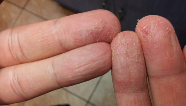 home remedies,cracked fingers,beauty tips,beauty