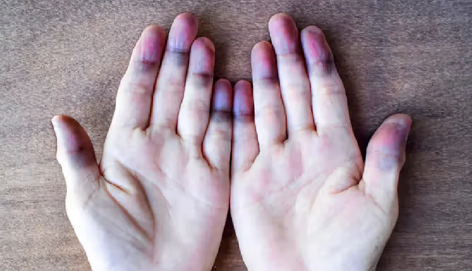 ठंड आते ही क्यों नीली पड़ने लगती हैं कुछ लोगों की उंगलियां? जानिए शरीर में किस कमी का है संकेत