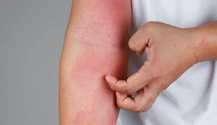 allergy symptoms,common allergies,types of allergies,food allergy,drug allergy,pollen allergy,mold allergy,seasonal allergy,latex allergy,pet allergy,allergy triggers,causes of allergy,immune system reaction,allergy management