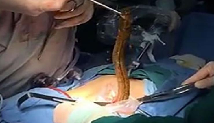 डॉक्टर्स ने शख्स के शरीर से निकाली 12 इंच से भी बड़ी मछली