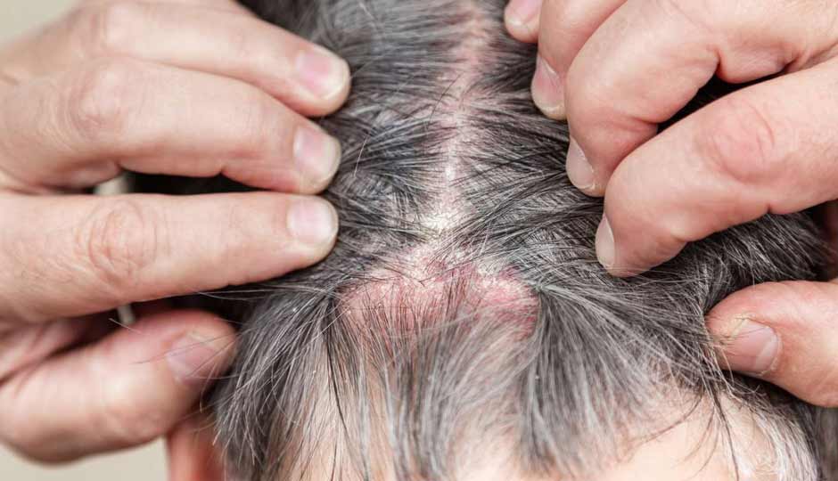 10 Home Remedies to Treat Pimple Like Flakes on the Scalp