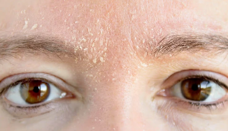 10 Natural Tips To Care for Flaky Skin