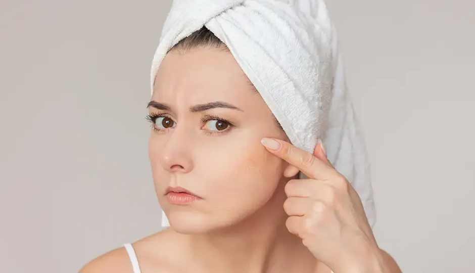 10 Home Remedies to Treat Flaky Skin in Monsoon