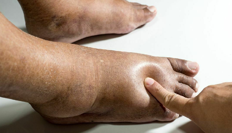 liver dysfunction signs,symptoms of liver issues,warning signs liver not functioning,liver health indicators,recognizing liver problems,abnormal liver function symptoms,liver disorder warning signals,detecting liver malfunction,signs of poor liver health,liver problem symptoms,liver disease symptoms,hepatic dysfunction signs,liver failure indicators,jaundice and liver health,liver function warning signs,cirrhosis symptoms,fatty liver symptoms,liver health red flags,liver disorder symptoms,hepatitis warning signs,liver damage symptoms,liver inflammation signs,alcoholic liver disease signs,liver health check symptoms,liver health complications