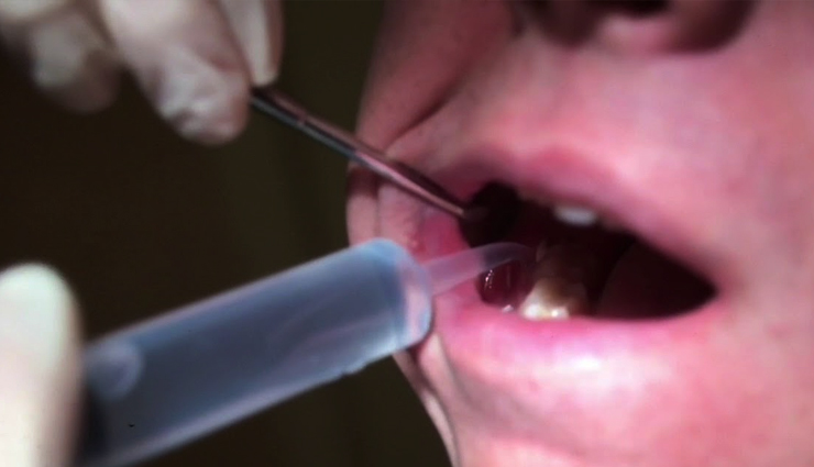 dry socket,alveolar osteitis,tooth extraction,home remedies,pain relief,natural remedies,warm salt water,clove oil,cold compress
    smoking cessation
    tea tree oil,garlic,honey,turmeric,aloe vera,chamomile tea,black tea bags,otc painkillers,soft food diet,Health,Health tips