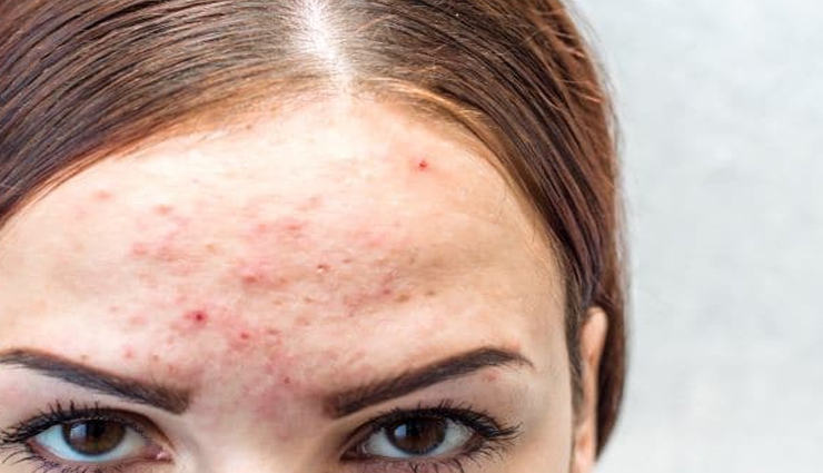 6 Natural Remedies To Treat Folliculitis
