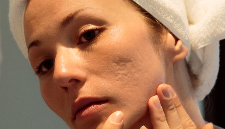 acne,food to get rid of acne,skin care tips,beauty tips