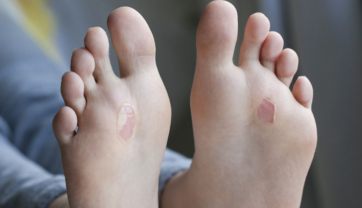 8 Natural Remedies To Treat Foot Blisters