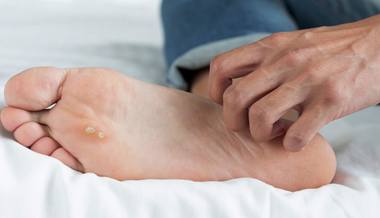 17 Effective Home Remedies To Treat Foot Fungus