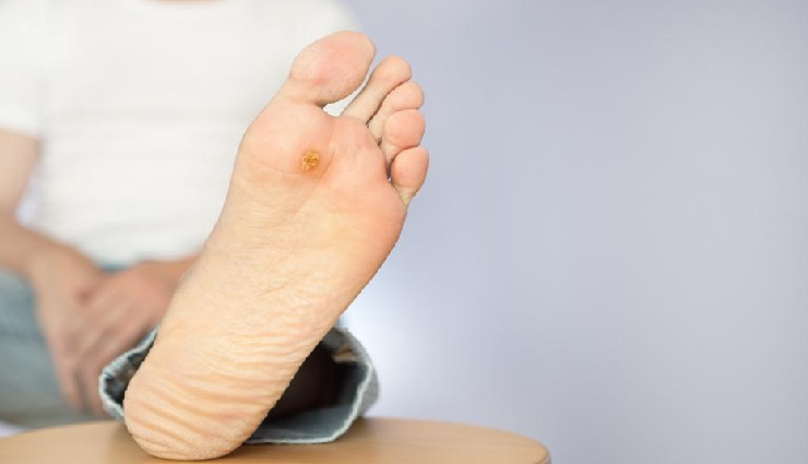 10 Home Remedies To Treat Foot Sores