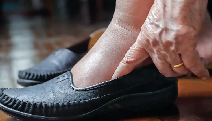 corns and calluses,corns and calluses treatment,symptoms of corns,symptoms of calluses,causes of corns,causes of calluses,how to treat corns,how to treat calluses,home remedies for corns,home remedies for calluses