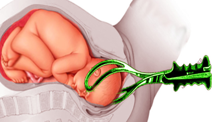 types of baby delivery methods every mom to be should know about,Health tips,healthy living