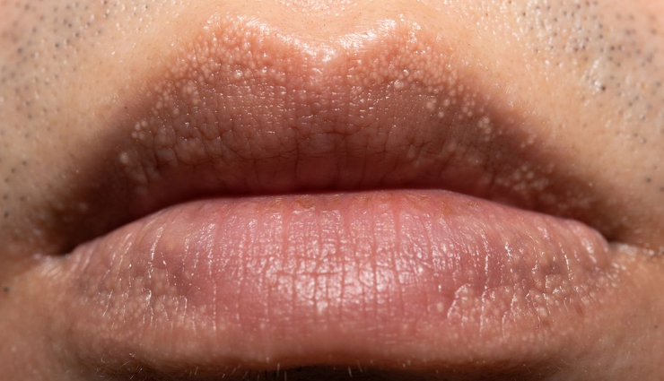 6 Must Try Remedies To Treat White Spots on Lips or Fordyce Spots Naturally