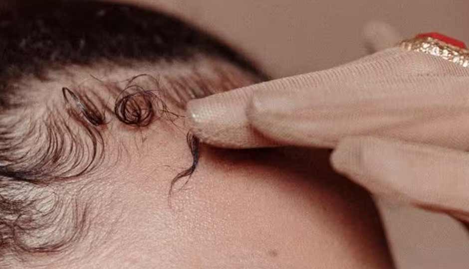 6 Home Remedies to Manage Excess Hair on the Forehead