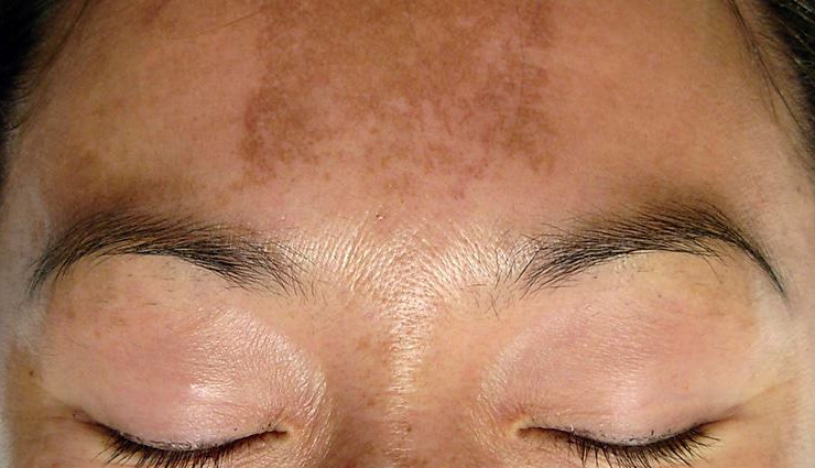 7 DIY Ways To Help You Treat Forehead Discoloration