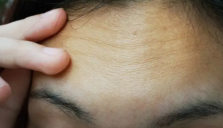 10 DIY Methods to Get Rid of Forehead Wrinkles