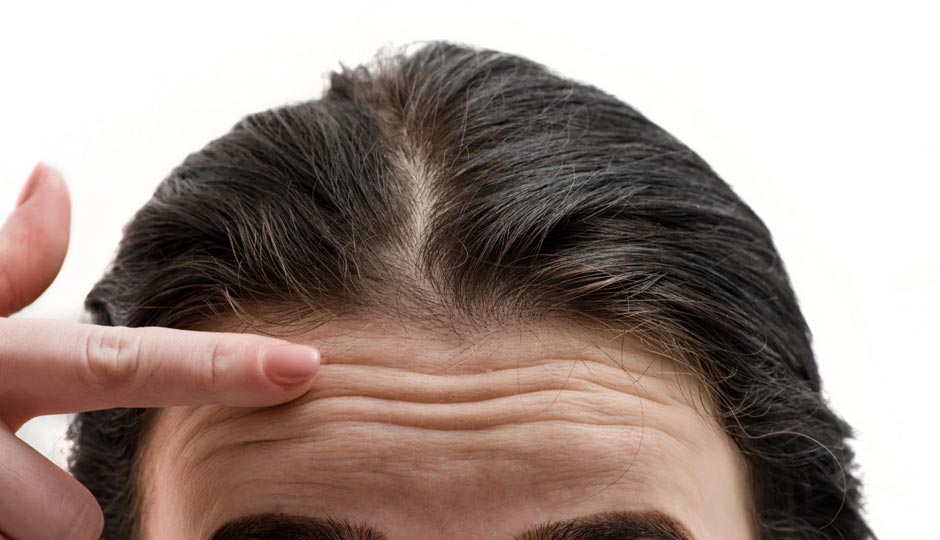8 Home Remedies to Treat Forehead Wrinkles