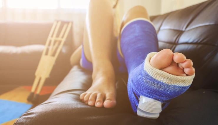 15 Home Remedies Best for Treating Fracture