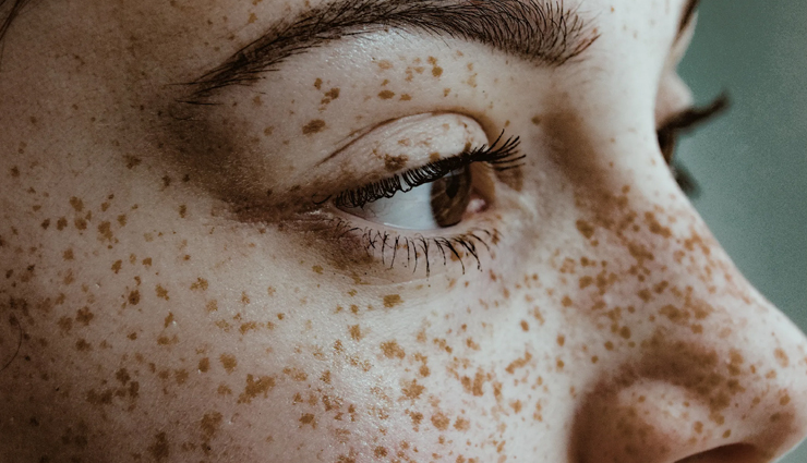 10 DIY Remedies That May Help Lighten Freckles