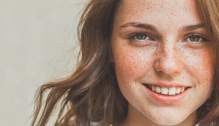 6 Ways To Get Rid of Freckles
