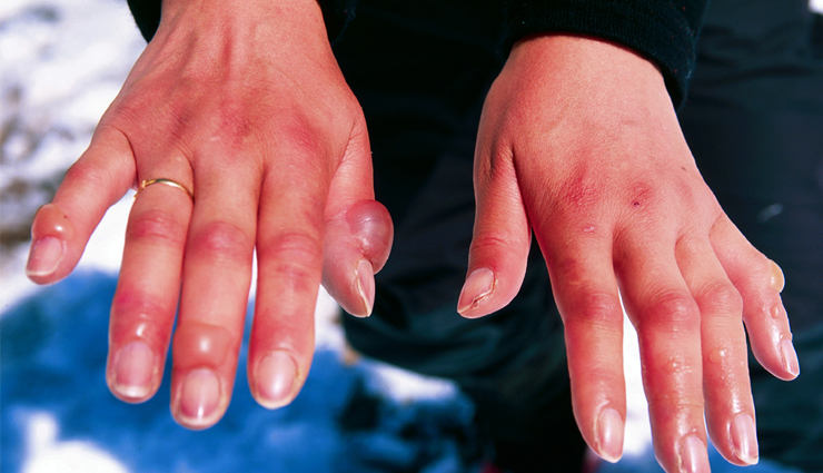 10 Useful Tips To Keep Yourself Safe From Frostbite