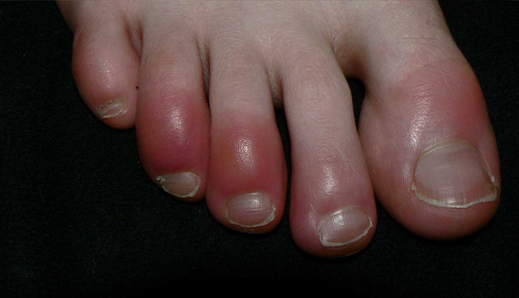 frostbite,tips to safe from frostbite,frostbite treatment,what is frostbite,Health,Health tips