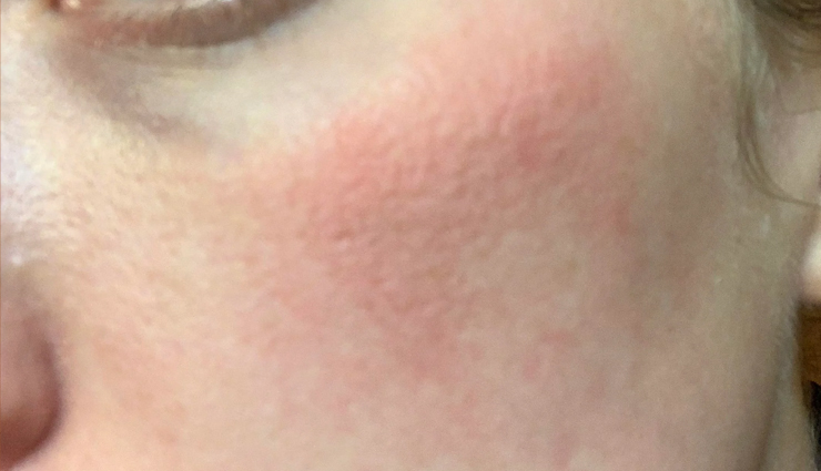 ice cubes on face disadvantages,rubbing ice cubes on face drawbacks,negative effects of using ice cubes on face,disadvantages of applying ice cubes on face,ice cube facial risks and drawbacks,problems with rubbing ice cubes on face,ice cube skincare disadvantages,potential drawbacks of using ice cubes on face,side effects of rubbing ice cubes on face,cons of applying ice cubes on face