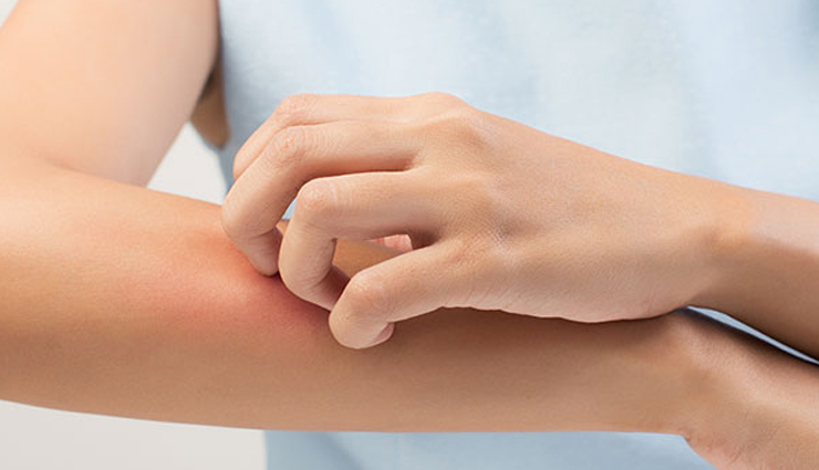 8 Home Remedies To Treat Mild Fungal Infections