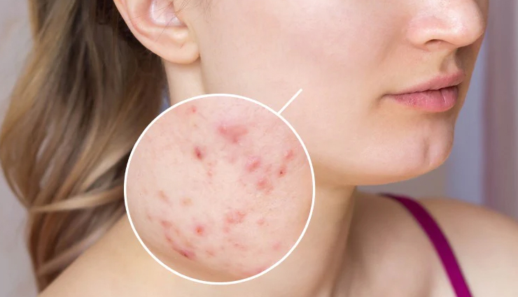 What is Fungal Acne? Major Causes, Symptoms and Treatments
