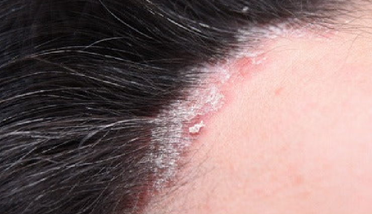 types of dandruff,dry scalp dandruff,oily scalp dandruff,fungal dandruff,psoriasis dandruff,seborrheic dermatitis,types of scalp conditions,dandruff causes,scalp health awareness,dandruff prevention tips