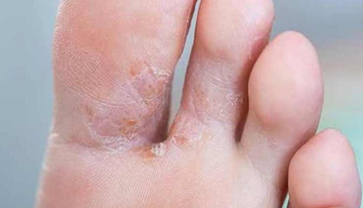 क्या आपको भी करना पड़ रहा है बरसात में फंगल इंफेक्शन का सामना, आजमाए ये 5 उपाय