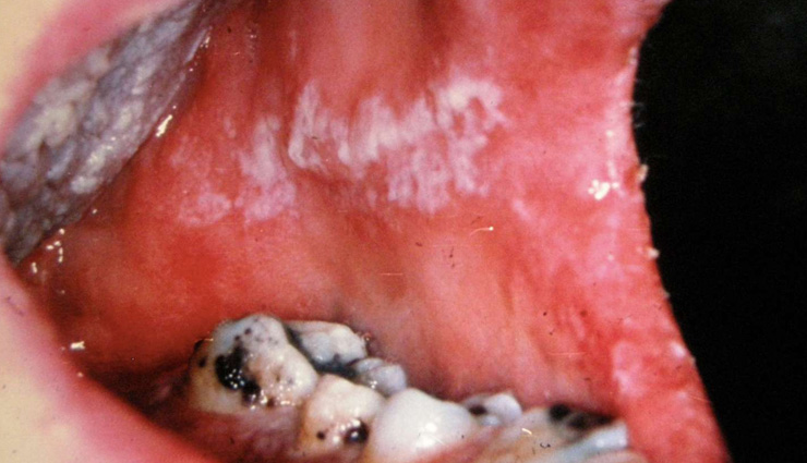 old-age dental problems,common dental issues for seniors,dry mouth solutions for elderly,missing teeth remedies,gum disease prevention for seniors,fungal infections in elderly,oral care tips for older adults,managing dental health in seniors,geriatric dental care tips,dental health for elderly