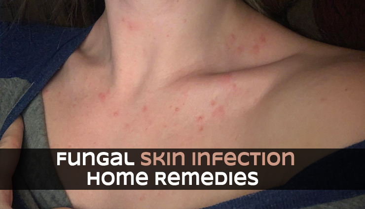 Effective Home Remedies To Treat Fungal Skin Infection