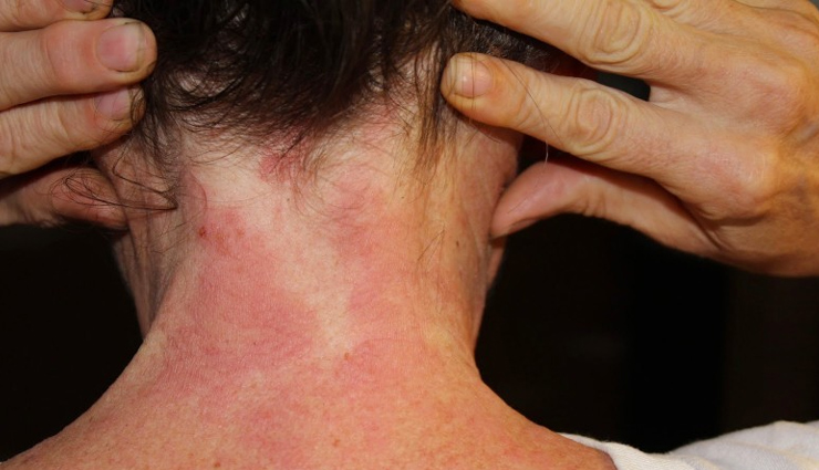 14 Remedies That are Effective in Treating Fungal Infection