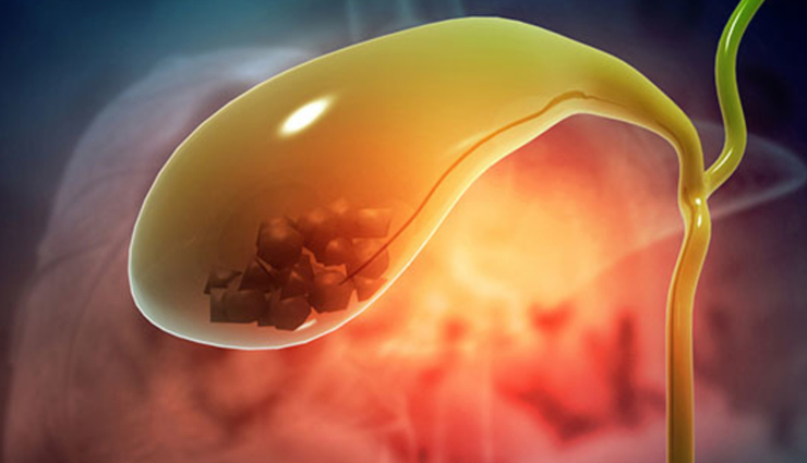 Suffering from the Pain of Gallstones? Try These Remedies for Relief and Treatment