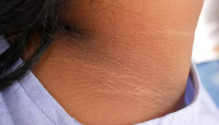 world thyroid day 2022,thyroid,hypothyroidism,hyperthyroidism,causes of thyroid,symptoms of thyroid,health news,healthy living