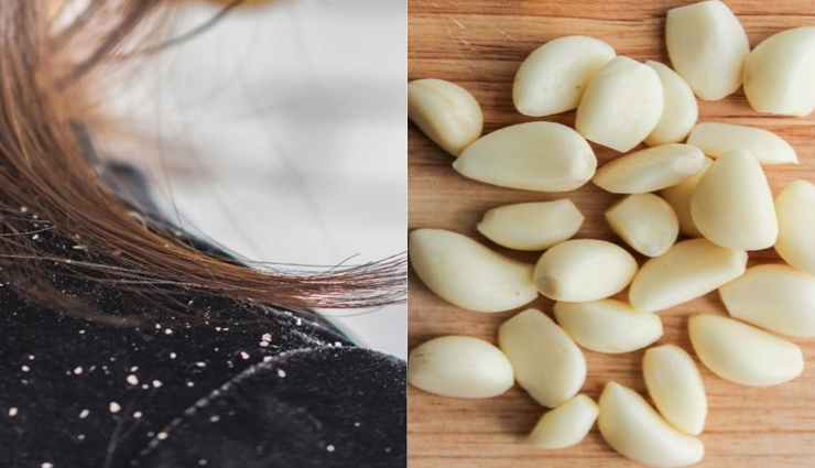 डैंड्रफ की समस्या को दूर करेगा लहसुन, इन 6 चीजों के साथ मिलाकर बनाए हेयर मास्क
