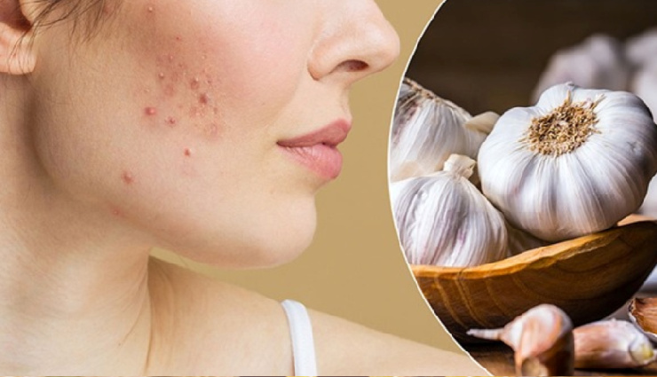 4 DIY Ways To Use Garlic To Treat Pimples