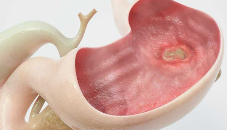 stomach problems,digestive issues,home remedies,stomach pain,bloating,indigestion,acidity,gastritis,constipation,diarrhea,heartburn,stomach ulcers,natural remedies,stomach discomfort