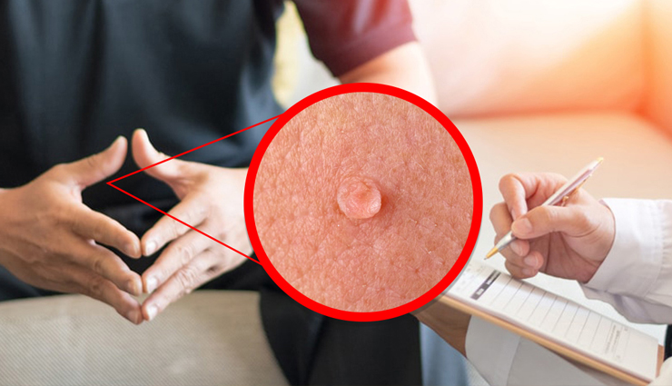 18 Ways To Treat Genital Warts at Home