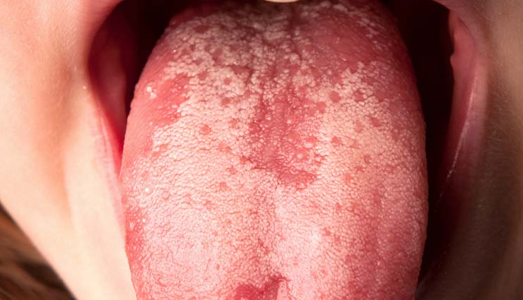 common mouth problems,tongue issues,dental hygiene,oral health concerns,mouth and tongue conditions,dental caries prevention,periodontal disease prevention,amalgam tattoo,halitosis treatment,black hairy tongue causes,canker sore remedies,tooth decay prevention,tooth abscess treatment,cold sore management,chipped tooth repair,leukoplakia diagnosis,lichen planus symptoms,thrush treatment,oral cancer detection,dry mouth remedies