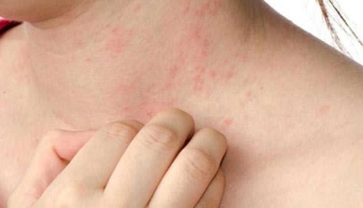 home remedies to get rid of urticaria,health tips in hindi,urticaria problem soloution