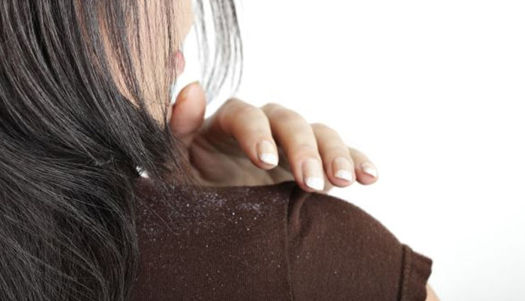 dandruff in winters,get rid of dandruff,hair care tips for winters,beauty tips for winters,beauty tips