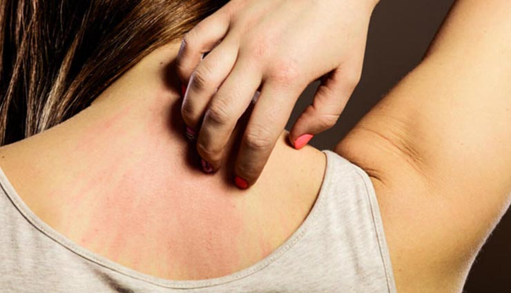 ये आसान उपाय दिलाएंगे खुजली और घमौरियों से राहत