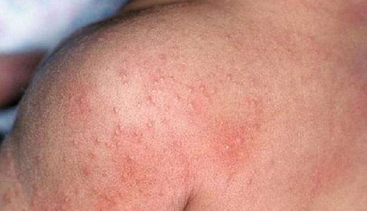 गर्मियों में परेशान करती हैं घमौरियां, जलन और खुजली से छुटकारा दिलाएंगे ये घरेलू उपाय