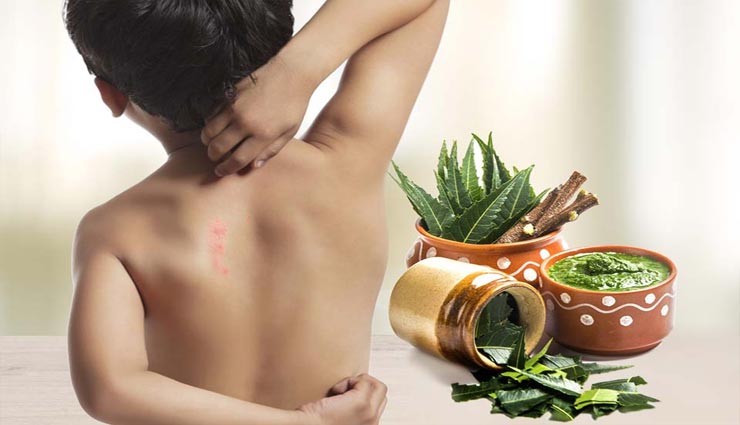 ये घरेलू टिप्स दिलाएँगे आपको घमौरियों से निजात, गर्मियों में मिलेगी राहत Health tips,health tips in hindi,humorous,home remedies,humorous remedies