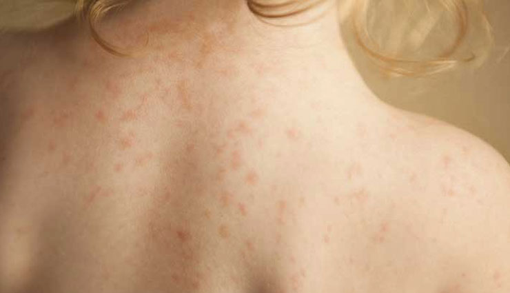 home remedies,ways to treat prickly heat rashes,prickly heat rashes,Health tips,healthy living