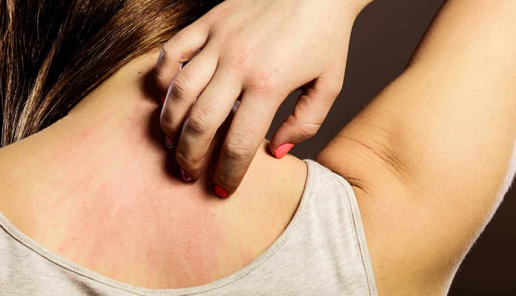 गर्मी के दिनों में उठती हैं घमौरियों की परेशानी, इन 10 उपायों से मिलेगी आपको राहत 